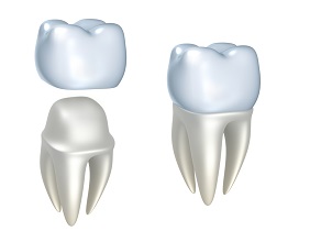 Dental Crown in Calgary NW