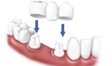 Porcelain Crowns In Calgary NW